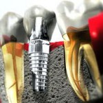 Implantes dentales precios